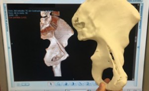 Traumatólogos del Hospital Virgen del Rocío imprimen en 3D réplicas exactas de los huesos de pacientes con fracturas