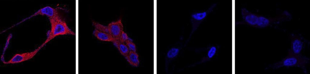 Un nuevo tratamiento para el cáncer de próstata usa nanopartículas orgánicas para destruir las células tumorales