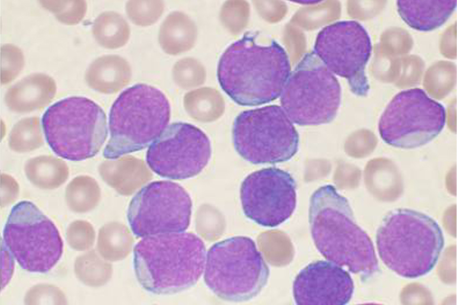 Identificado un nuevo mecanismo de migración celular utilizado por las células de leucemia